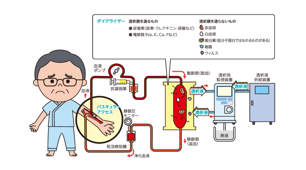 血液透析（HD）の仕組みのイラスト図